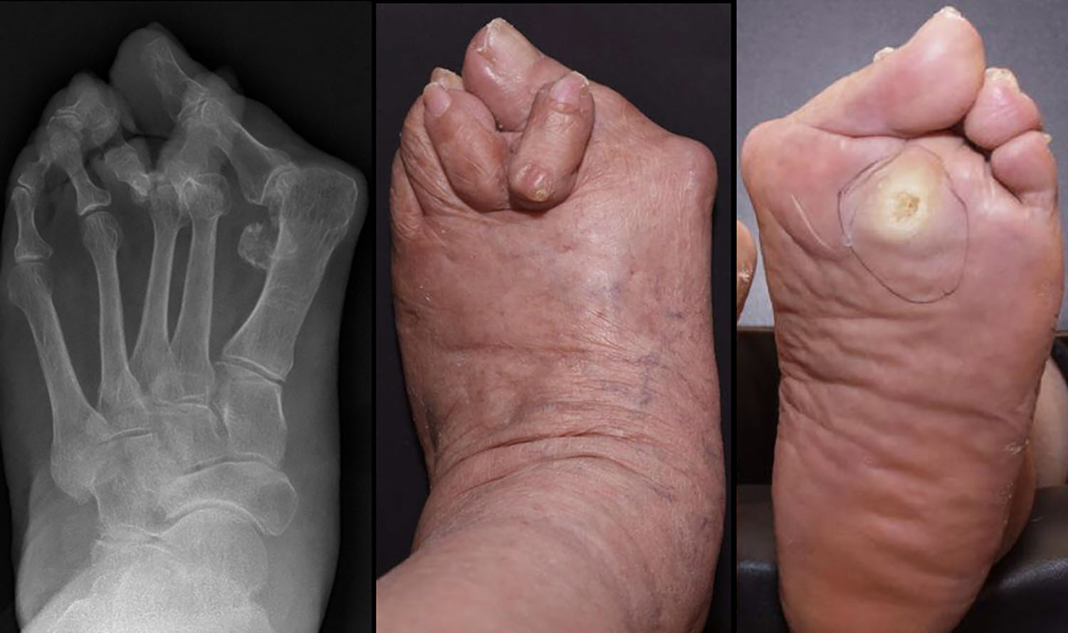 Severe Bunion X Ray